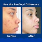 PanOxyl Acne Foaming Wash 156g - Image 2